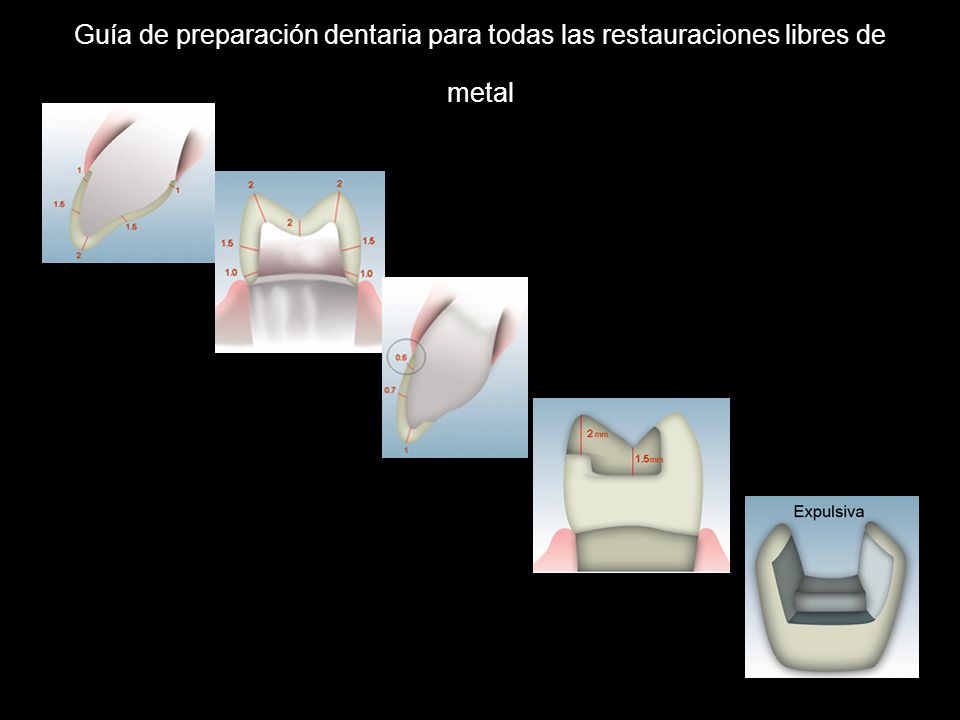Guía de preparación dentaria para todas las restauraciones libres de metal