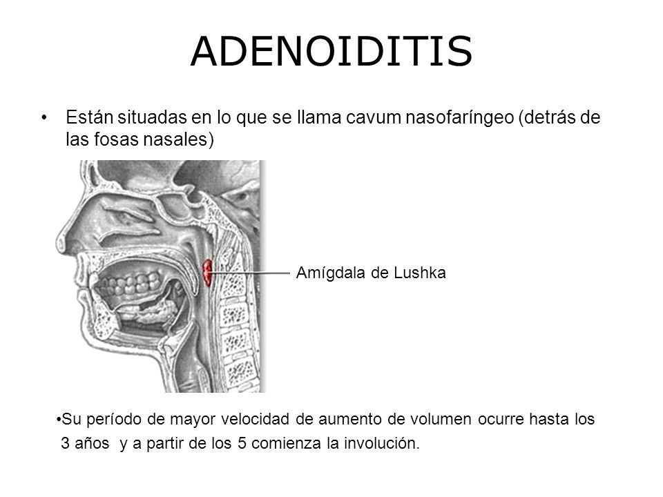 ADENOIDITIS Están situadas en lo que se llama cavum nasofaríngeo (detrás de las fosas nasales) Amígdala de Lushka.