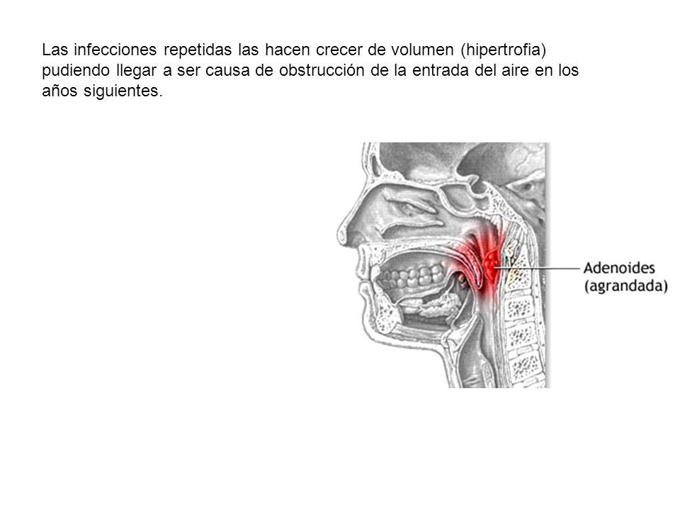 Las infecciones repetidas las hacen crecer de volumen (hipertrofia) pudiendo llegar a ser causa de obstrucción de la entrada del aire en los años siguientes.