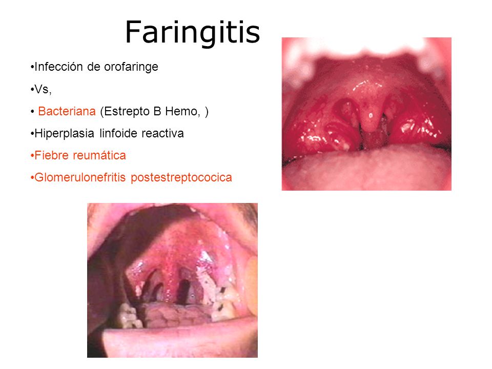 Faringitis Infección de orofaringe Vs, Bacteriana (Estrepto B Hemo, )