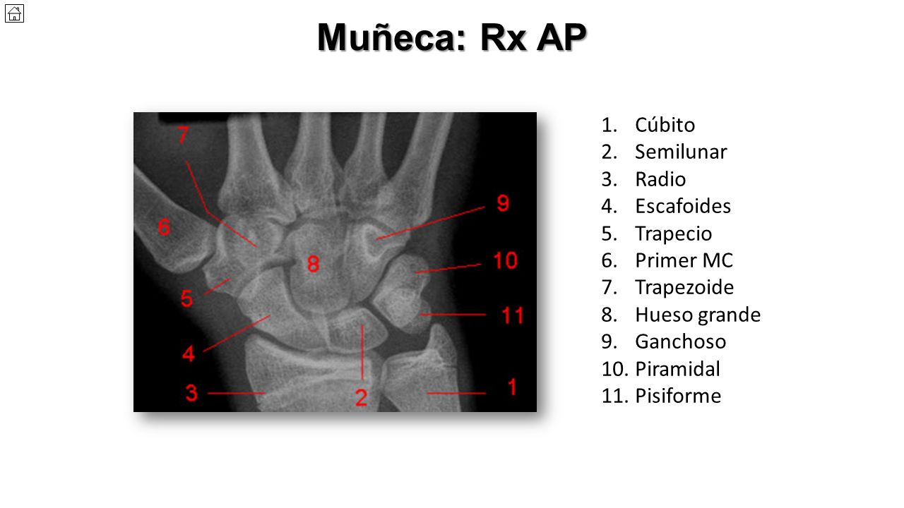 Muñeca: Rx AP Cúbito Semilunar Radio Escafoides Trapecio Primer MC