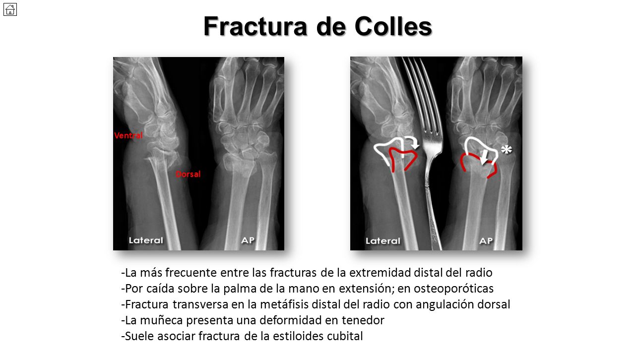 Fractura de Colles Ventral. Dorsal. -La más frecuente entre las fracturas de la extremidad distal del radio.