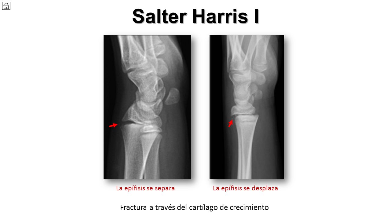 Salter Harris I Fractura a través del cartílago de crecimiento