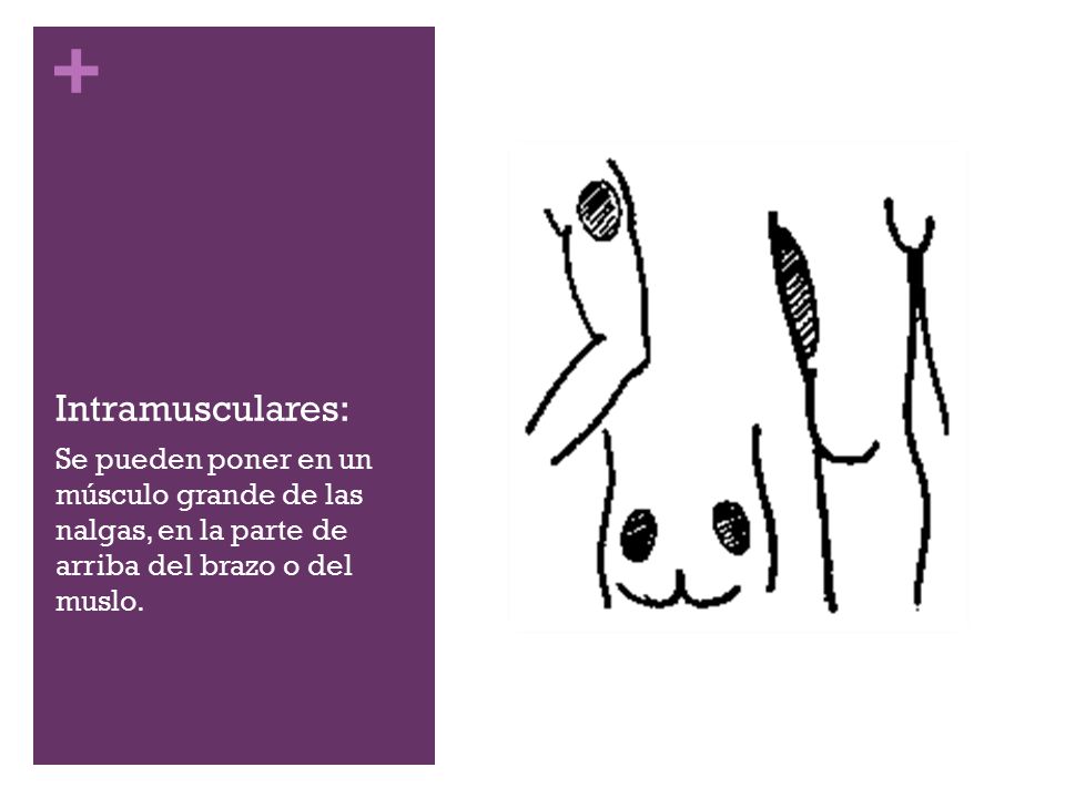 Intramusculares: Se pueden poner en un músculo grande de las nalgas, en la parte de arriba del brazo o del muslo.