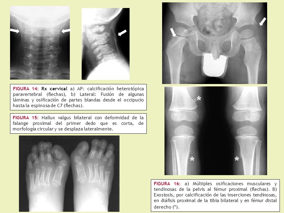 FIGURA 14: Rx cervical a) AP: calcificación heterotópica paravertebral (flechas), b) Lateral: Fusión de algunas láminas y osificación de partes blandas desde el occipucio hasta la espinosa de C7 (flechas).