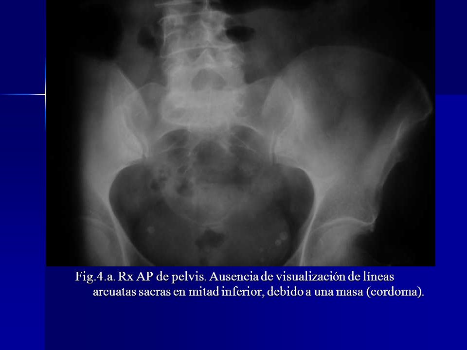 Fig.4.a. Rx AP de pelvis.