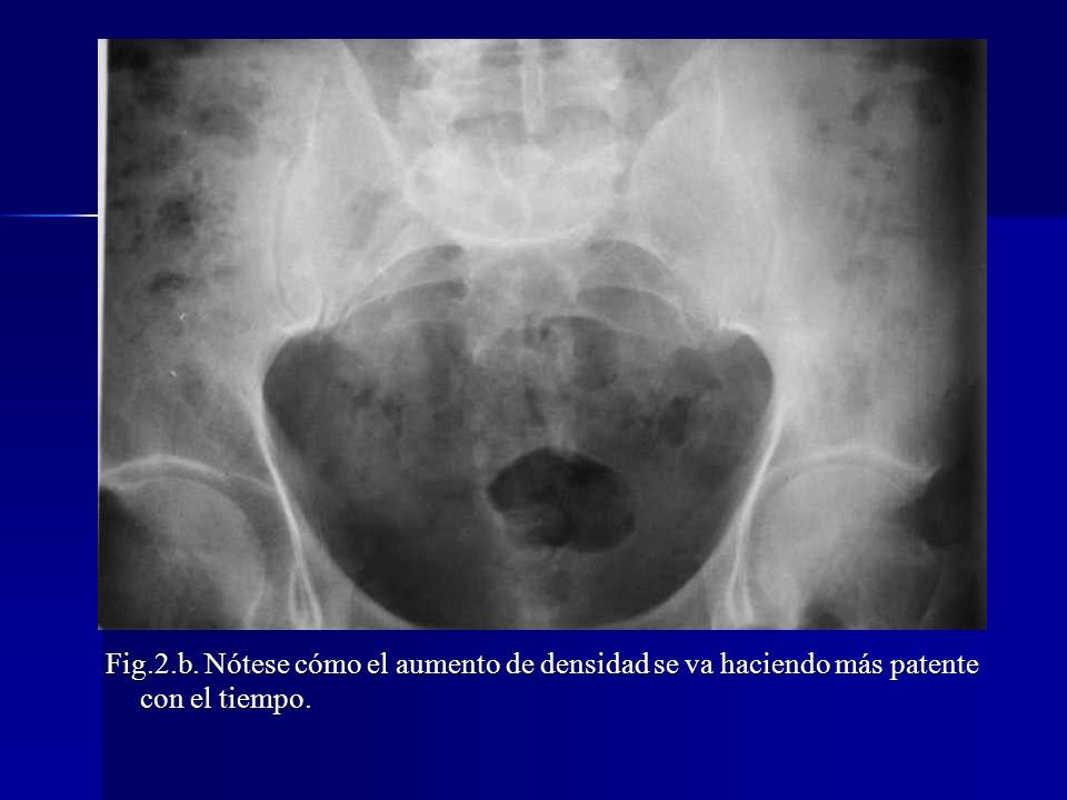 Fig.2.b. Nótese cómo el aumento de densidad se va haciendo más patente con el tiempo.