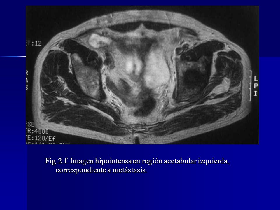 Fig.2.f. Imagen hipointensa en región acetabular izquierda, correspondiente a metástasis.
