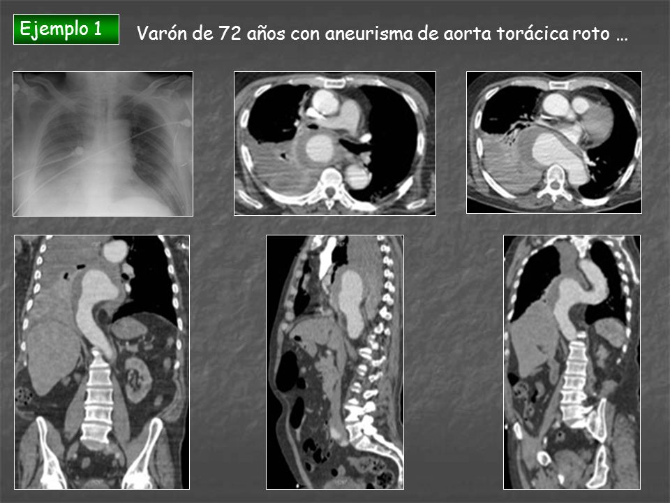 Ejemplo 1 Varón de 72 años con aneurisma de aorta torácica roto …