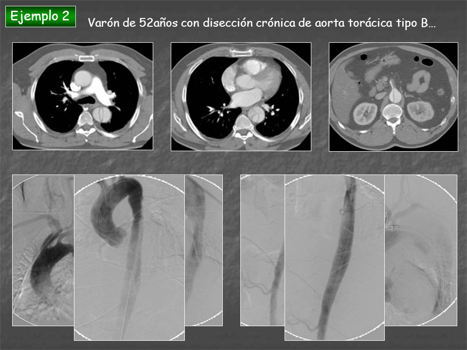 Ejemplo 2 Varón de 52años con disección crónica de aorta torácica tipo B…