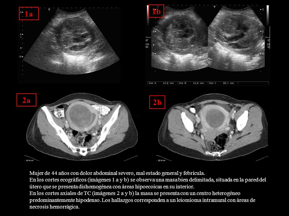 1b 1a. 2a. 2b. Figura : Mujer de 44 años con dolor abdominal severo, mal estado general y febrícula.