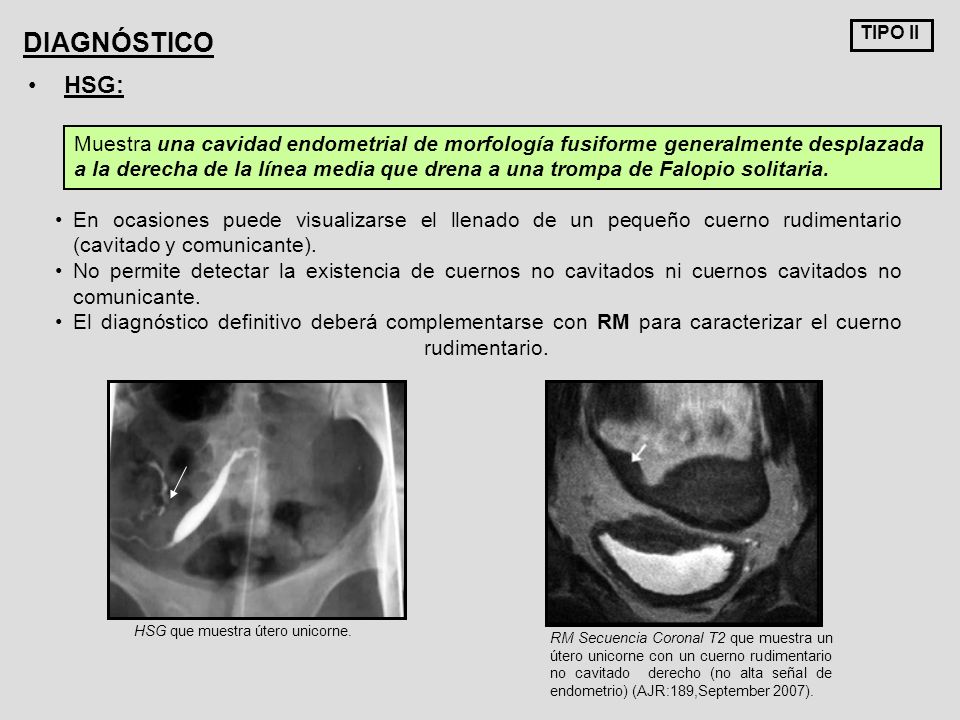TIPO II DIAGNÓSTICO. HSG: Muestra una cavidad endometrial de morfología fusiforme generalmente desplazada.