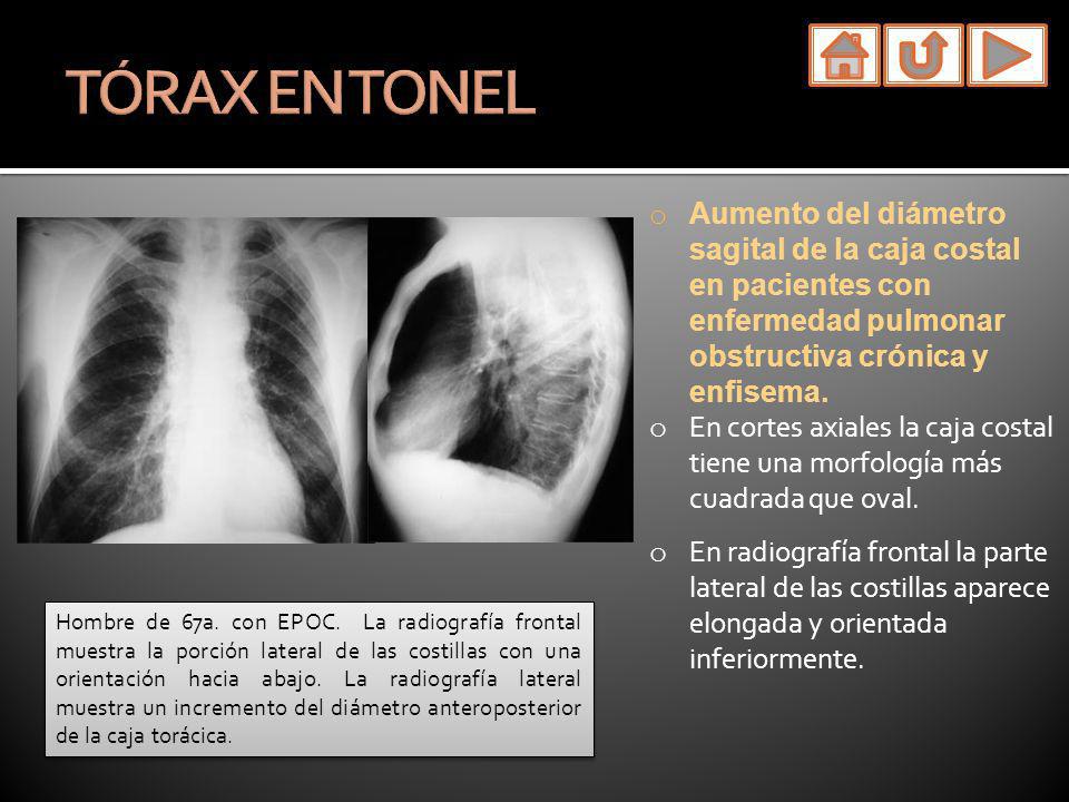TÓRAX EN TONEL Aumento del diámetro sagital de la caja costal en pacientes con enfermedad pulmonar obstructiva crónica y enfisema.