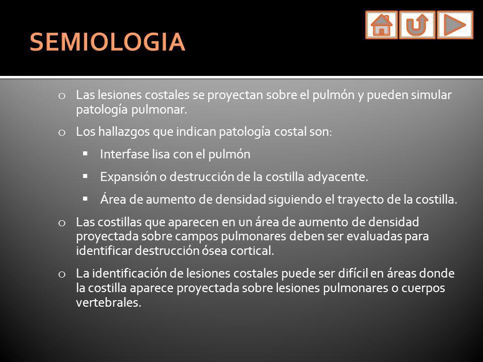 SEMIOLOGIA Las lesiones costales se proyectan sobre el pulmón y pueden simular patología pulmonar.