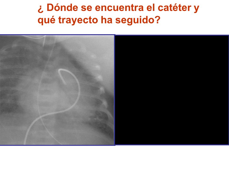 ¿ Dónde se encuentra el catéter y qué trayecto ha seguido