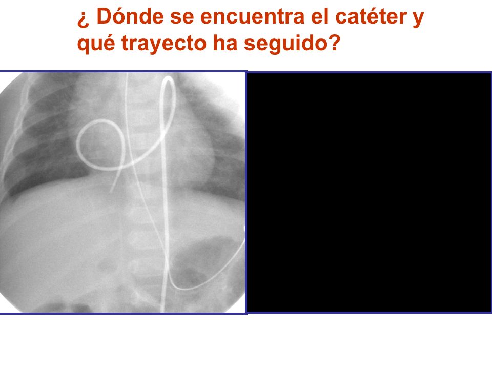 ¿ Dónde se encuentra el catéter y qué trayecto ha seguido