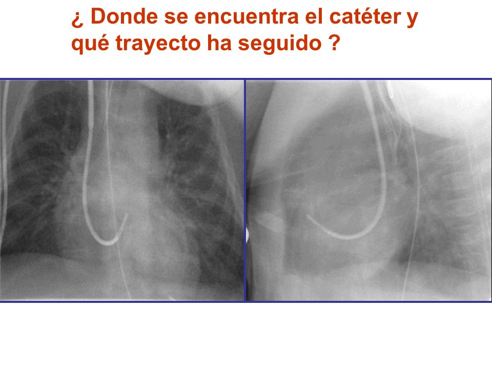 ¿ Donde se encuentra el catéter y qué trayecto ha seguido