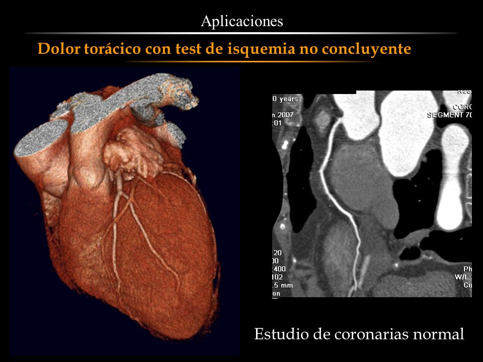 Aplicaciones Dolor torácico con test de isquemia no concluyente Estudio de coronarias normal