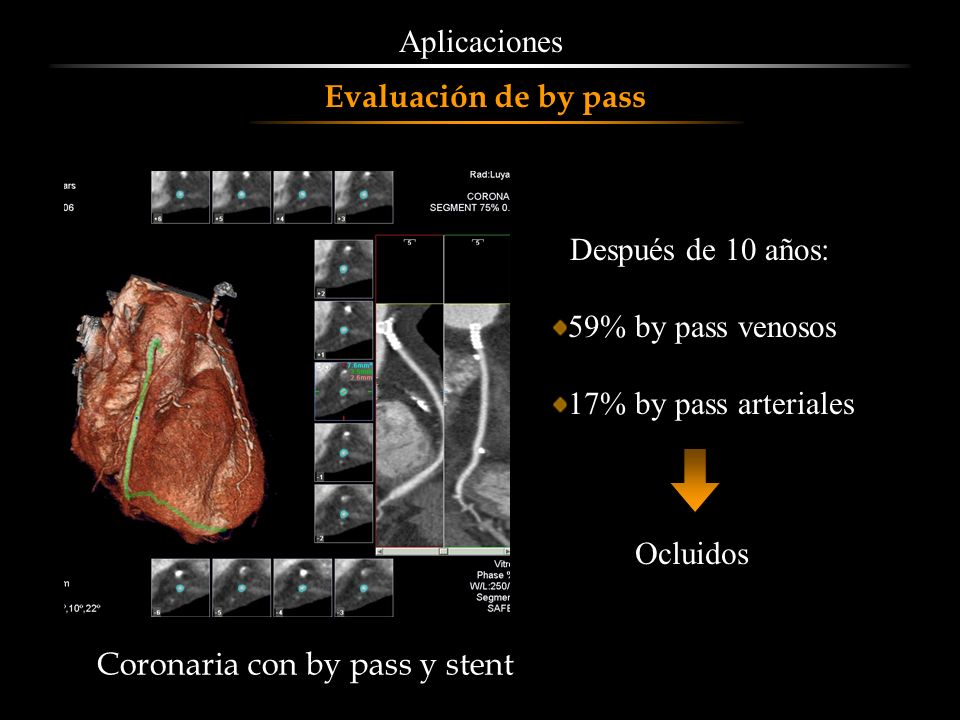Aplicaciones Evaluación de by pass. Después de 10 años: 59% by pass venosos. 17% by pass arteriales.
