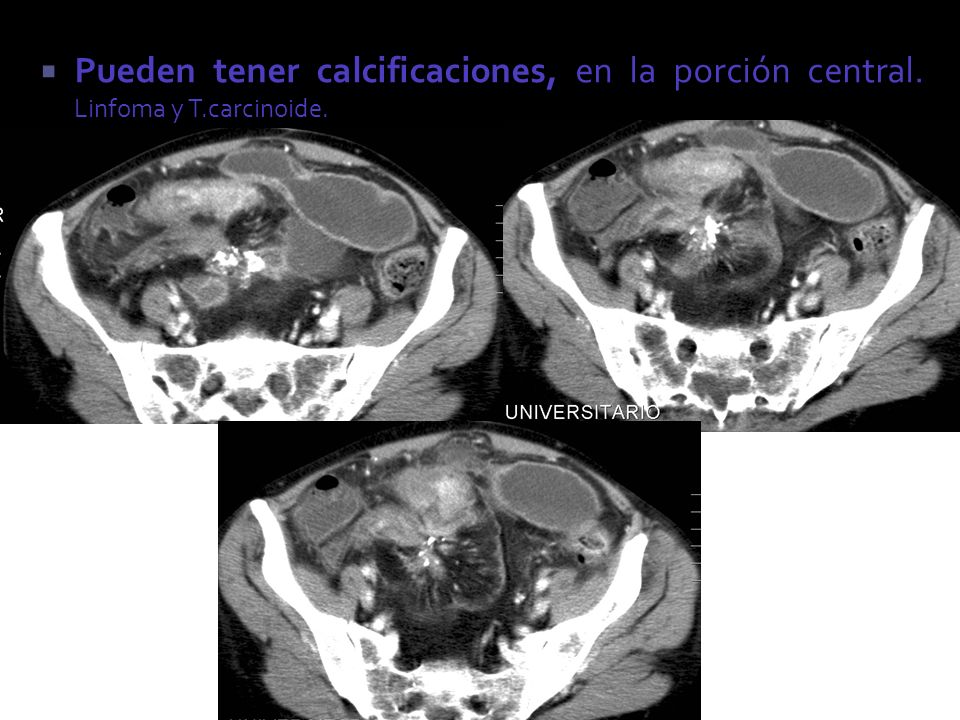 Pueden tener calcificaciones, en la porción central. Linfoma y T