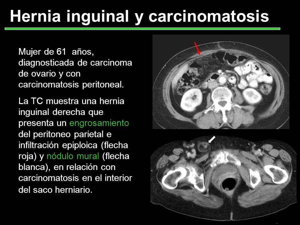 Hernia inguinal y carcinomatosis