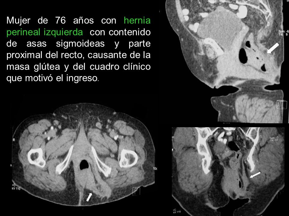 Mujer de 76 años con hernia perineal izquierda con contenido de asas sigmoideas y parte proximal del recto, causante de la masa glútea y del cuadro clínico que motivó el ingreso.