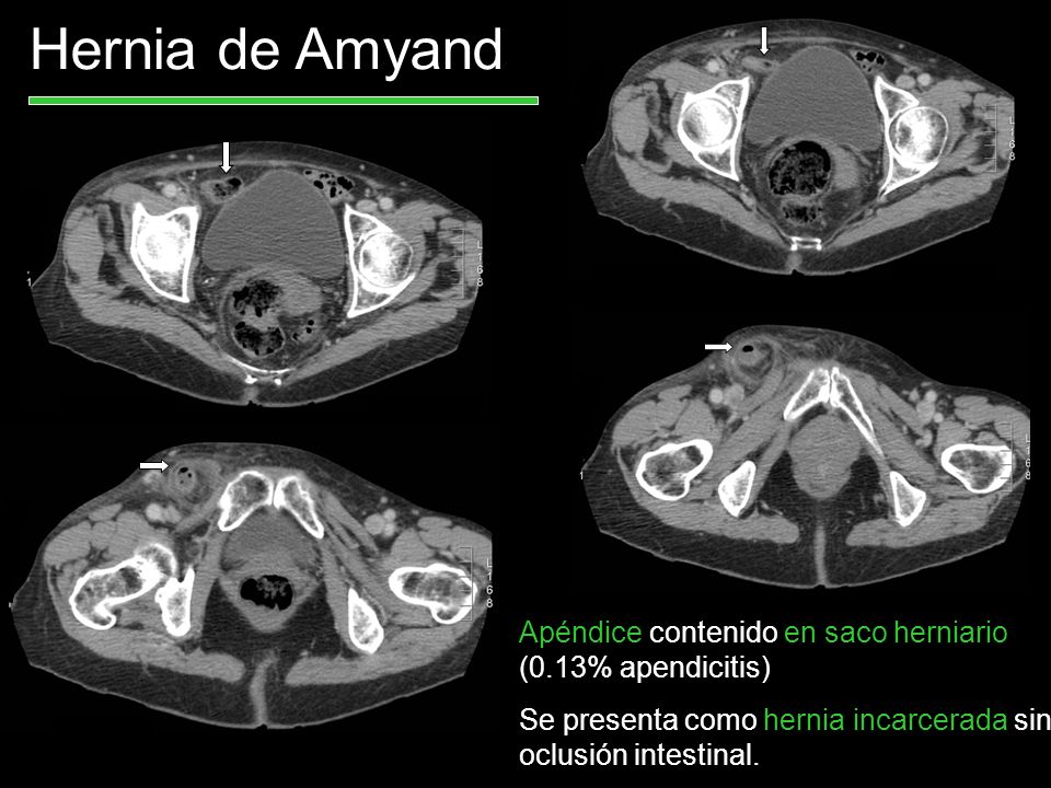 Hernia de Amyand Apéndice contenido en saco herniario (0.13% apendicitis) Se presenta como hernia incarcerada sin oclusión intestinal.