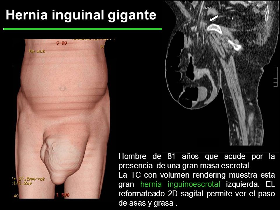 Hernia inguinal gigante
