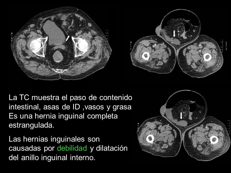 La TC muestra el paso de contenido intestinal, asas de ID ,vasos y grasa Es una hernia inguinal completa estrangulada.