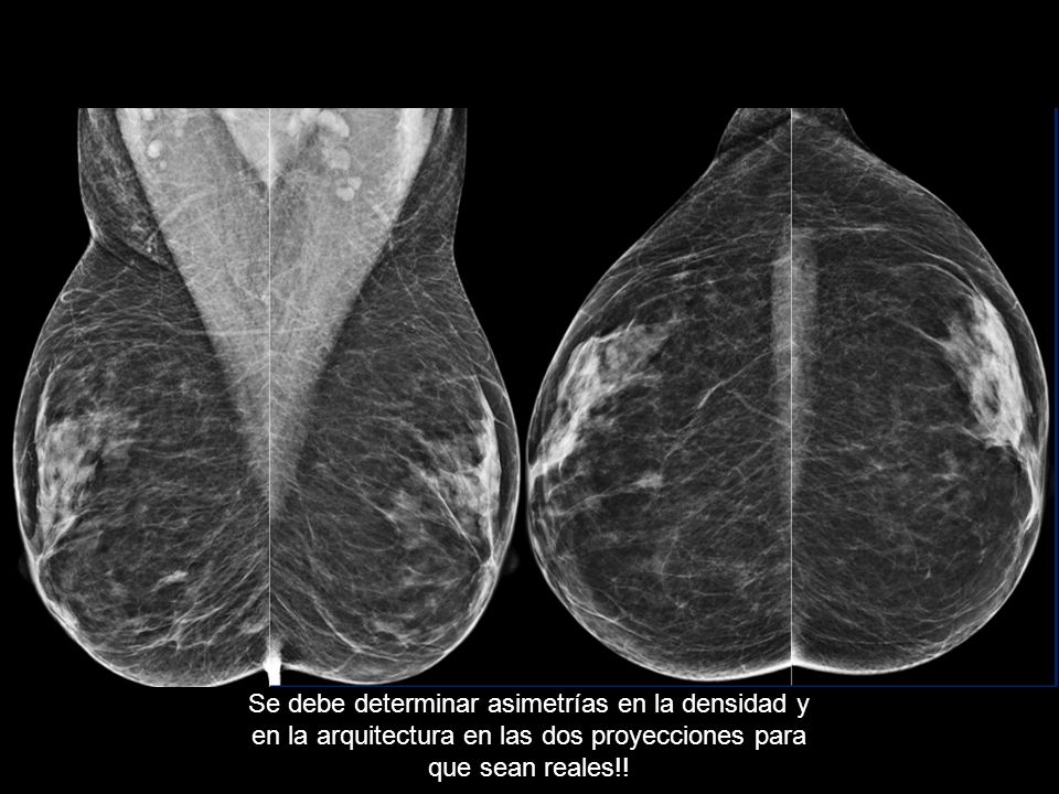 Se debe determinar asimetrías en la densidad y en la arquitectura en las dos proyecciones para que sean reales!!