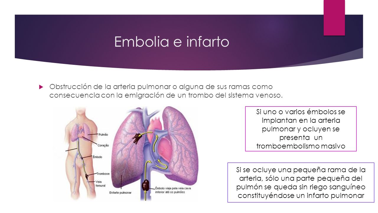 Embolia e infarto Obstrucción de la arteria pulmonar o alguna de sus ramas como consecuencia con la emigración de un trombo del sistema venoso.