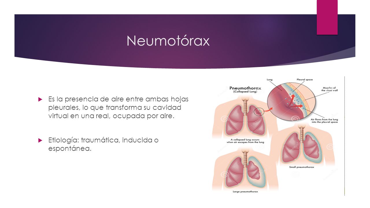 Neumotórax Es la presencia de aire entre ambas hojas pleurales, lo que transforma su cavidad virtual en una real, ocupada por aire.