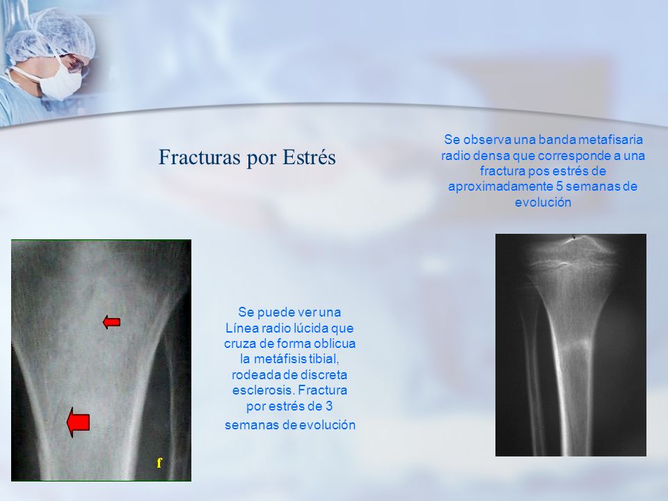 Se observa una banda metafisaria radio densa que corresponde a una fractura pos estrés de aproximadamente 5 semanas de evolución