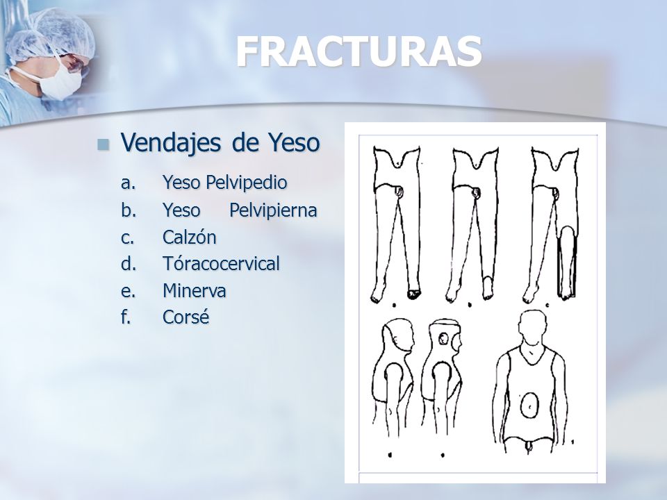 FRACTURAS Vendajes de Yeso a. Yeso Pelvipedio b. Yeso Pelvipierna