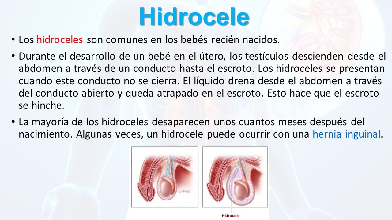 Hidrocele Los hidroceles son comunes en los bebés recién nacidos.