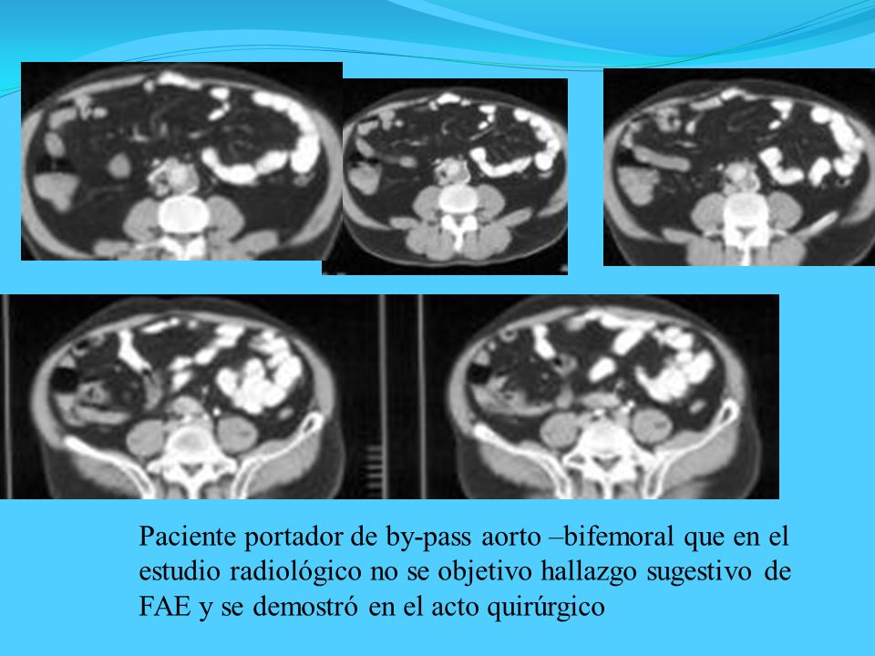 Paciente portador de by-pass aorto –bifemoral que en el estudio radiológico no se objetivo hallazgo sugestivo de FAE y se demostró en el acto quirúrgico
