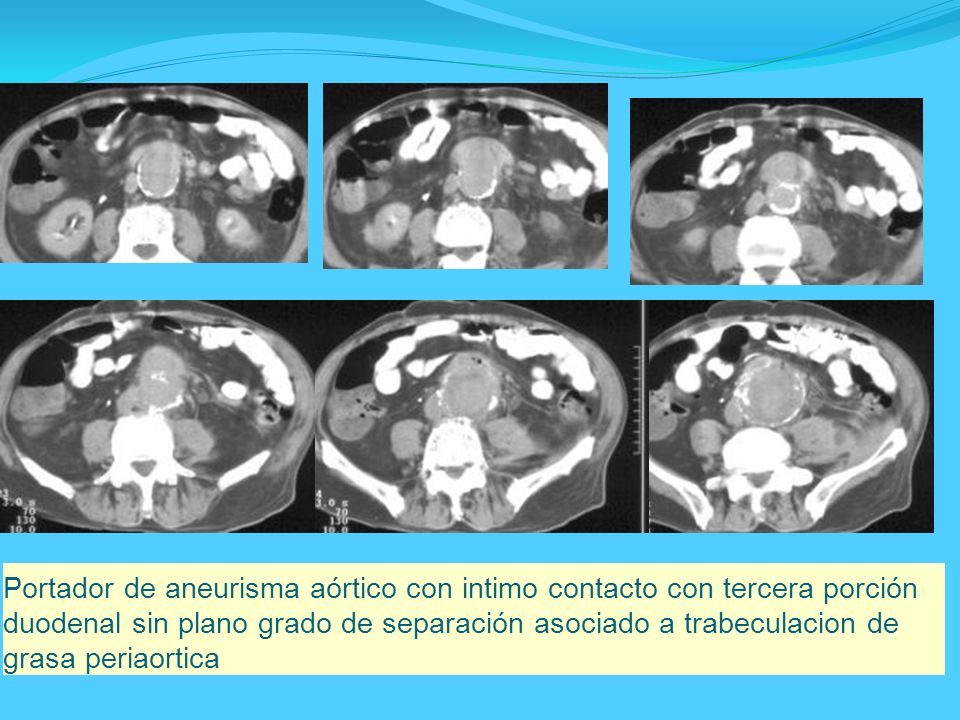 Portador de aneurisma aórtico con intimo contacto con tercera porción duodenal sin plano grado de separación asociado a trabeculacion de grasa periaortica