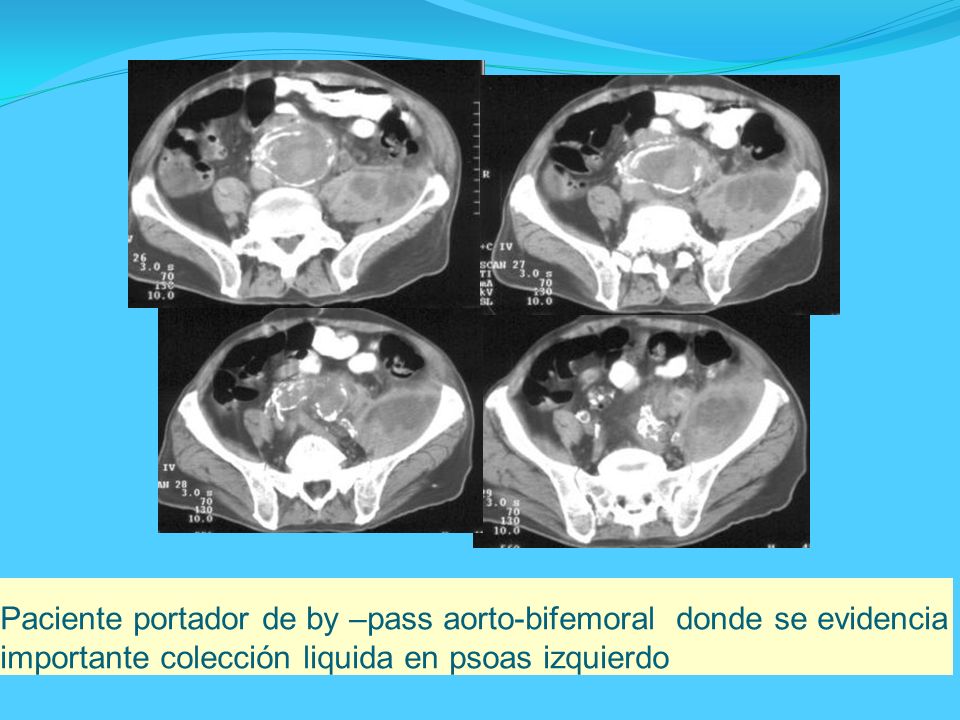 Paciente portador de by –pass aorto-bifemoral donde se evidencia importante colección liquida en psoas izquierdo