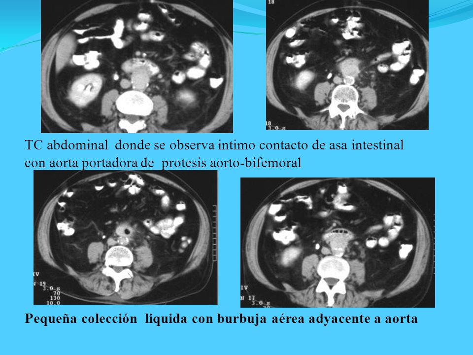 TC abdominal donde se observa intimo contacto de asa intestinal con aorta portadora de protesis aorto-bifemoral