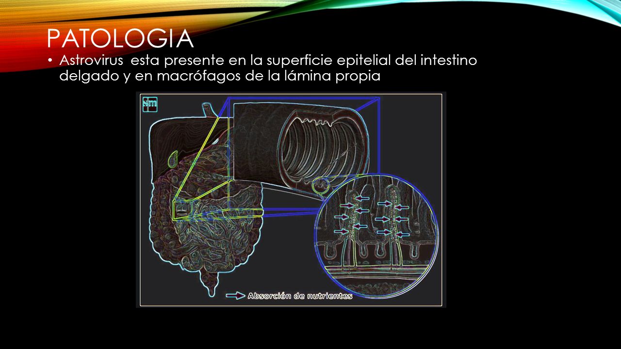 patologia Astrovirus esta presente en la superficie epitelial del intestino delgado y en macrófagos de la lámina propia.