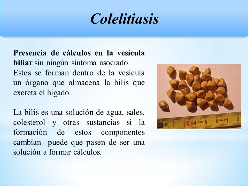 Colelitiasis Presencia de cálculos en la vesícula biliar sin ningún síntoma asociado.