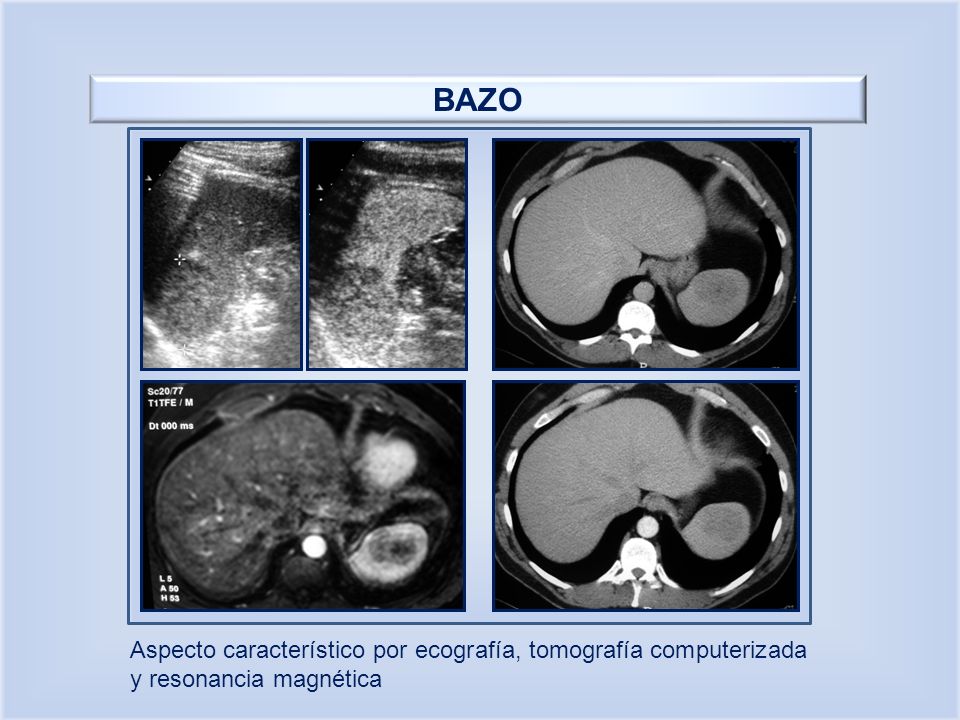 BAZO Aspecto característico por ecografía, tomografía computerizada y resonancia magnética