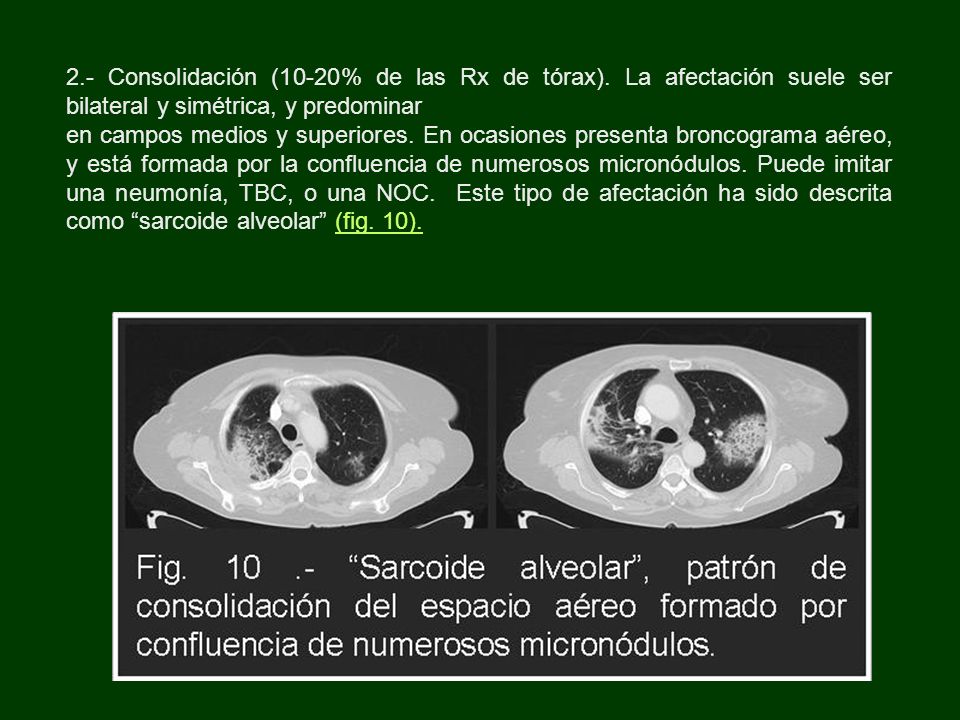 2. - Consolidación (10-20% de las Rx de tórax)