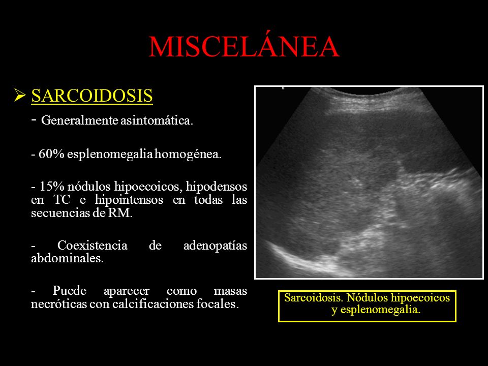 Sarcoidosis. Nódulos hipoecoicos y esplenomegalia.