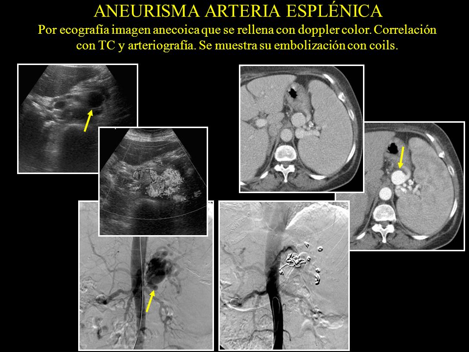 ANEURISMA ARTERIA ESPLÉNICA Por ecografía imagen anecoica que se rellena con doppler color.