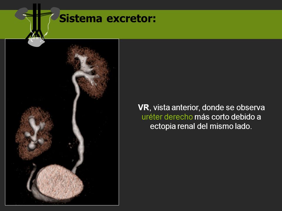 Sistema excretor: VR, vista anterior, donde se observa