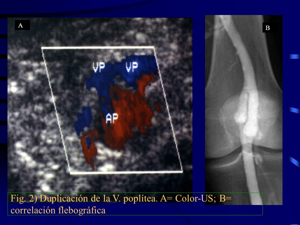 A B Fig. 2) Duplicación de la V. poplítea. A= Color-US; B= correlación flebográfica