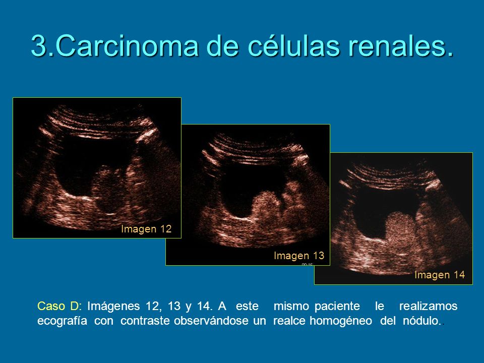 3.Carcinoma de células renales.