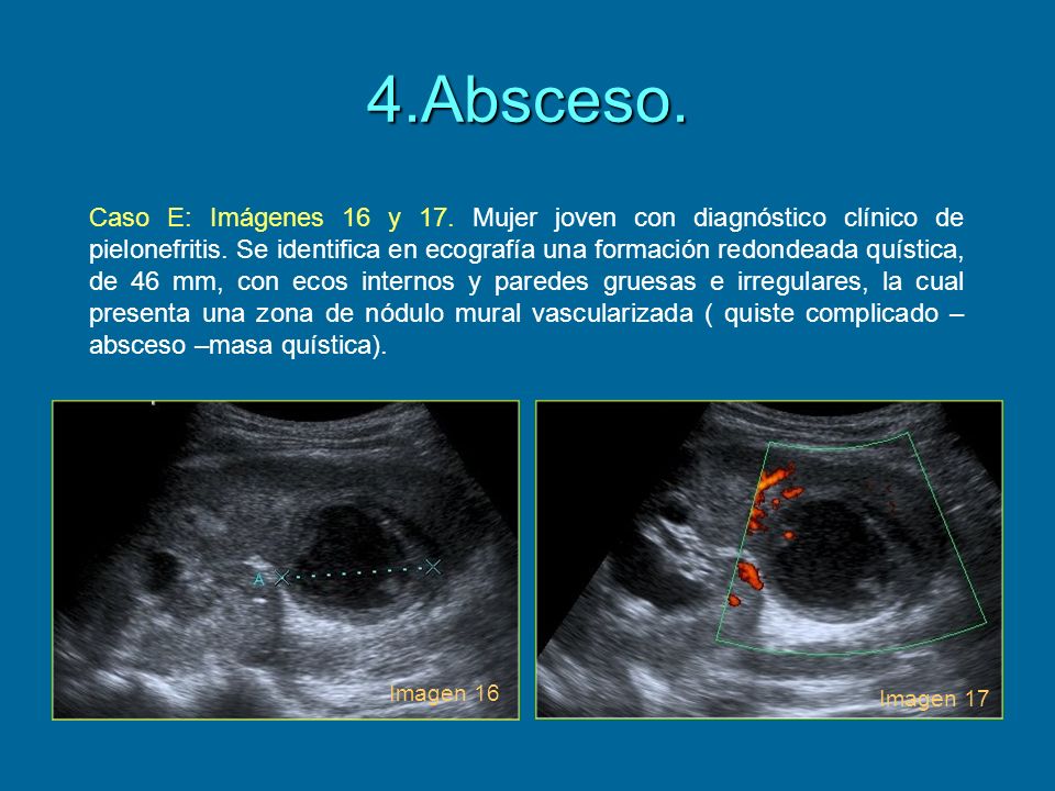 4.Absceso.