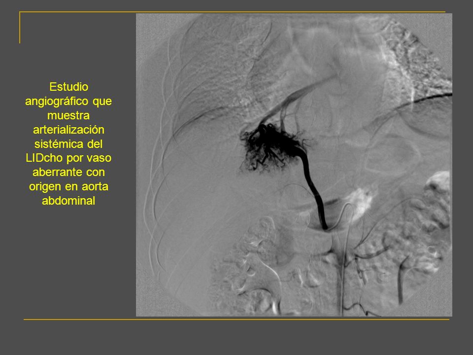 Estudio angiográfico que muestra arterialización sistémica del LIDcho por vaso aberrante con origen en aorta abdominal